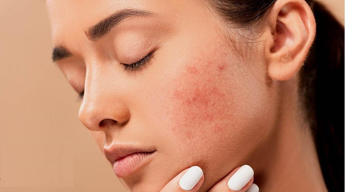how to get rid of pimples on your face at home